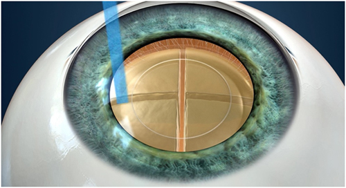 Singapore Bladeless Laser Cataract Surgery II